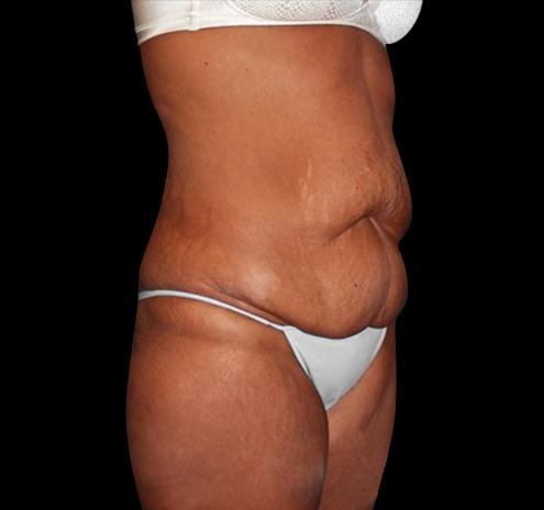 New Jersey Tummy Tuck Before & After Gallery - Patient 55432714 - Image 9