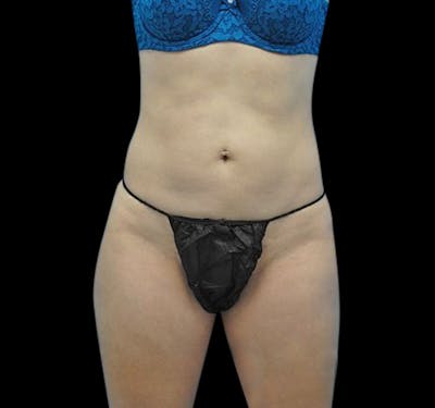 Liposuction Before & After Gallery - Patient 55432683 - Image 2