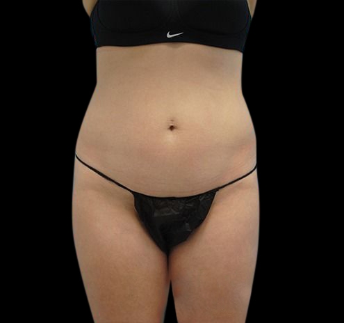 New Jersey Liposuction Before & After Gallery - Patient 55432683 - Image 1