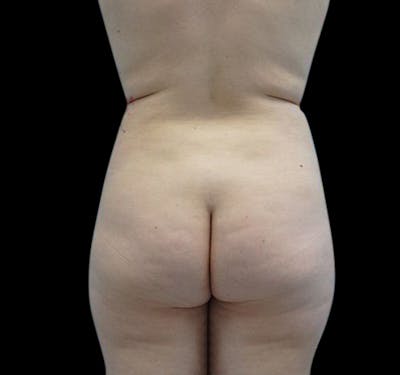 New Jersey Liposuction Before & After Gallery - Patient 55436972 - Image 2