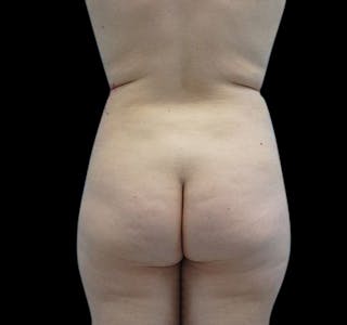 Liposuction Before & After Gallery - Patient 55432684 - Image 2