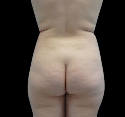Liposuction Gallery - Patient 55432684 - Image 2