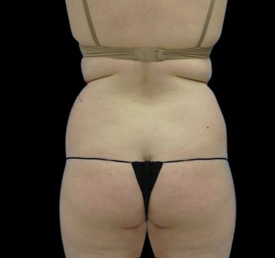 New Jersey Liposuction Before & After Gallery - Patient 55436972 - Image 1