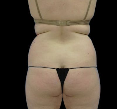 New Jersey Facial Liposuction Before & After Gallery - Patient 55436972 - Image 1