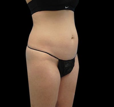 New Jersey Liposuction Before & After Gallery - Patient 55432683 - Image 3