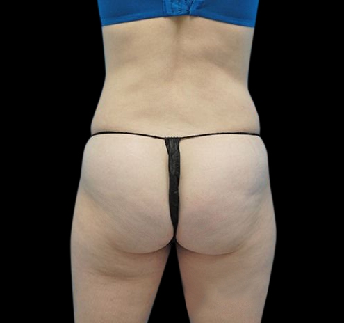 New Jersey Liposuction Before & After Gallery - Patient 55432683 - Image 6