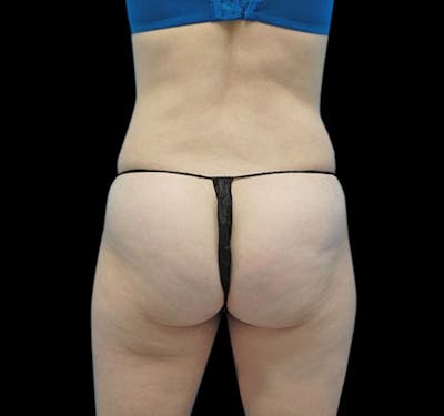 Liposuction Before & After Gallery - Patient 55432683 - Image 6