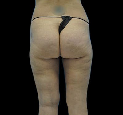 New Jersey Liposuction Before & After Gallery - Patient 55432685 - Image 2