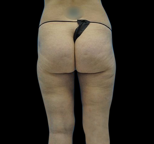 Liposuction Before & After Gallery - Patient 55432685 - Image 2