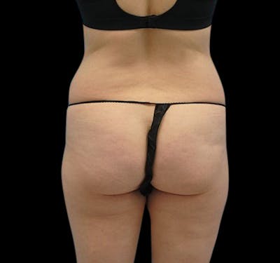 Liposuction Gallery - Patient 55432683 - Image 5