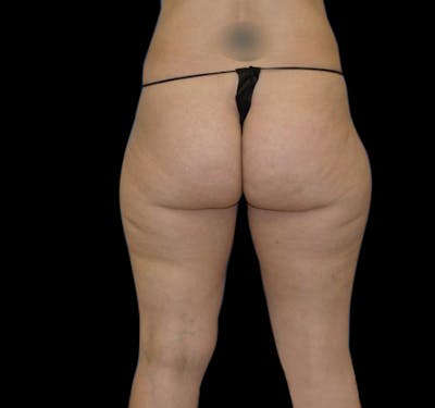 Liposuction Before & After Gallery - Patient 55432685 - Image 1