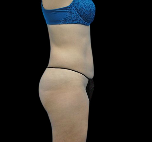 Liposuction Before & After Gallery - Patient 55432683 - Image 8