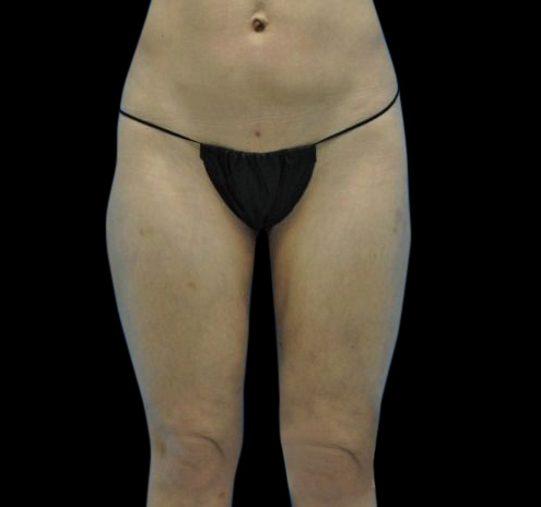 Liposuction Before & After Gallery - Patient 55432685 - Image 4