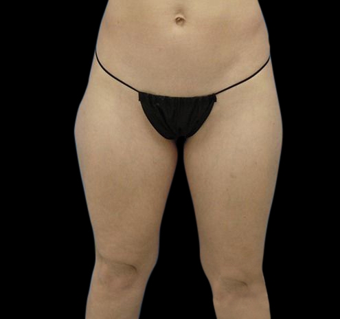 Liposuction Before & After Gallery - Patient 55432685 - Image 3