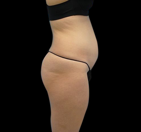 New Jersey Liposuction Before & After Gallery - Patient 55432683 - Image 7
