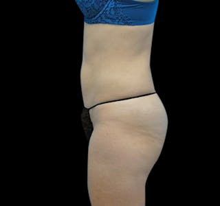 Liposuction Before & After Gallery - Patient 55432683 - Image 10