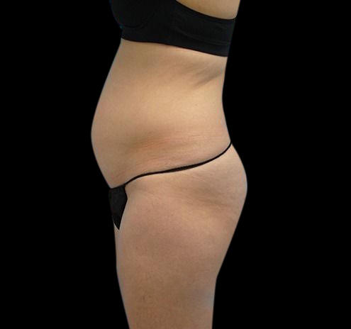 Liposuction Before & After Gallery - Patient 55432683 - Image 9