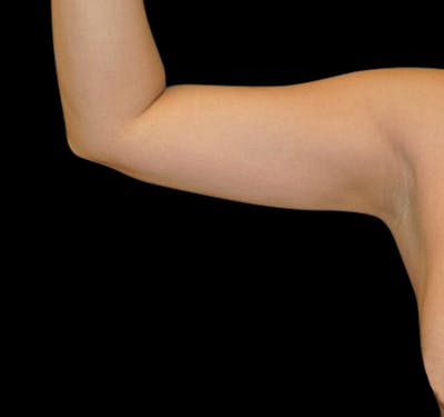 New Jersey Liposuction Before & After Gallery - Patient 55437063 - Image 2