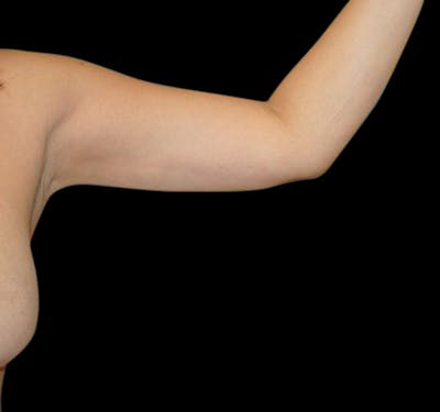 New Jersey Liposuction Before & After Gallery - Patient 55432689 - Image 4
