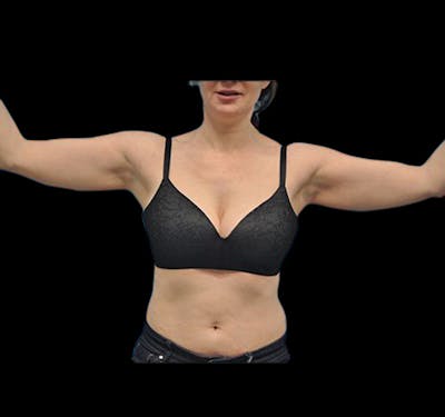 New Jersey Liposuction Before & After Gallery - Patient 55432691 - Image 3