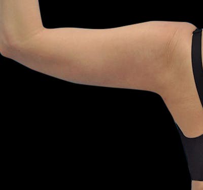 New Jersey Liposuction Before & After Gallery - Patient 55432691 - Image 6