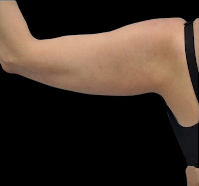 New Jersey Liposuction Before & After Gallery - Patient 55432691 - Image 5