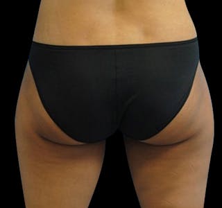 CoolSculpting® Before & After Gallery - Patient 55433990 - Image 2
