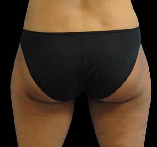 New Jersey CoolSculpting® Before & After Gallery - Patient Mdf2cYy6SVGRWHcKR6j9Bw - Image 2