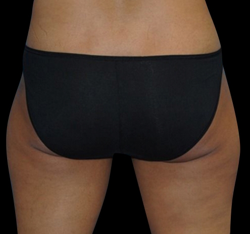 New Jersey CoolSculpting® Before & After Gallery - Patient 183571 - Image 1