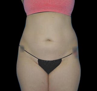 CoolSculpting® Before & After Gallery - Patient 55435880 - Image 2