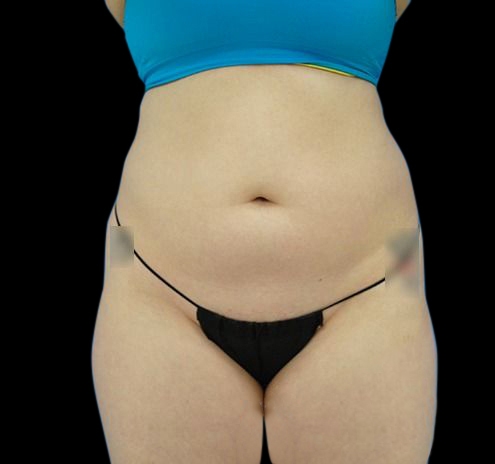 New Jersey CoolSculpting® Before & After Gallery - Patient 55434004 - Image 1