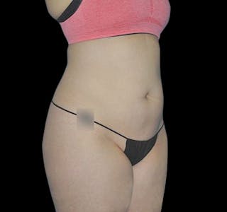 New Jersey CoolSculpting® Before & After Gallery - Patient 55435880 - Image 4