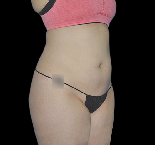 CoolSculpting® Before & After Gallery - Patient 55434004 - Image 4