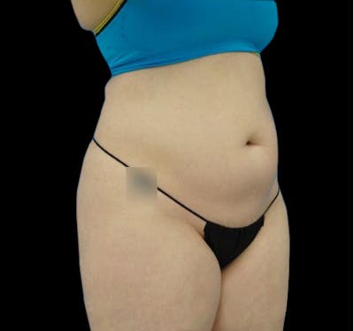 CoolSculpting® Before & After Gallery - Patient 55435880 - Image 3