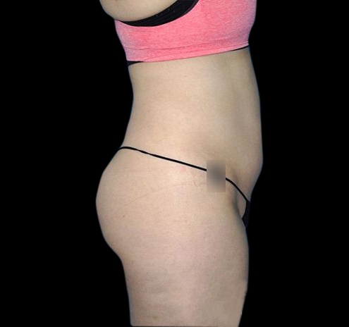 CoolSculpting® Before & After Gallery - Patient 55435880 - Image 6