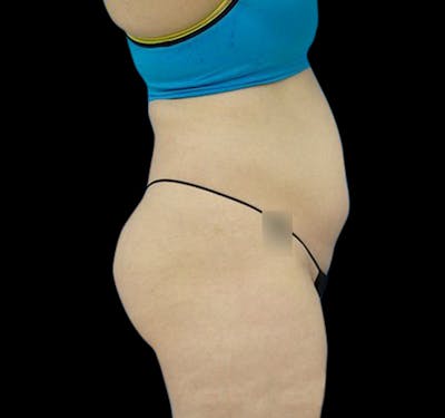 New Jersey CoolSculpting® Before & After Gallery - Patient 55435880 - Image 5