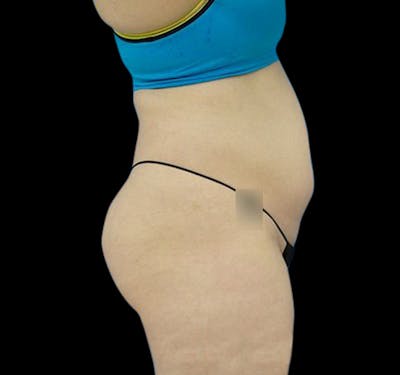 CoolSculpting® Before & After Gallery - Patient 55435880 - Image 5