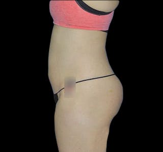 New Jersey CoolSculpting® Before & After Gallery - Patient 55434004 - Image 8