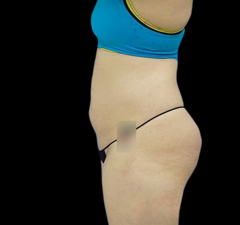 New Jersey CoolSculpting® Before & After Gallery - Patient 55435880 - Image 7