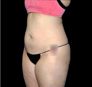 CoolSculpting® Before & After Gallery - Patient 55434004 - Image 10