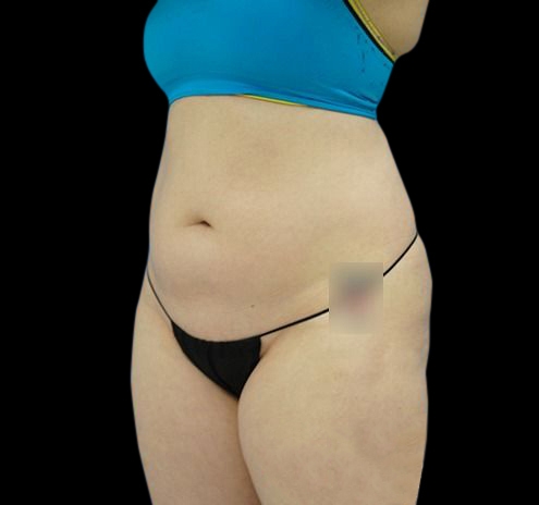 New Jersey CoolSculpting® Before & After Gallery - Patient 55435880 - Image 9