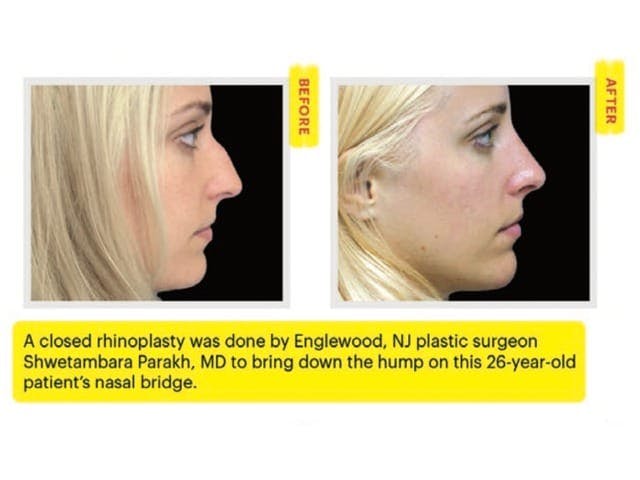 Closed Rhinoplasty