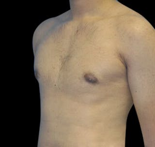 Gynecomastia Before & After Gallery - Patient 55432625 - Image 6