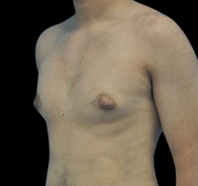Gynecomastia Before & After Gallery - Patient 55432625 - Image 5