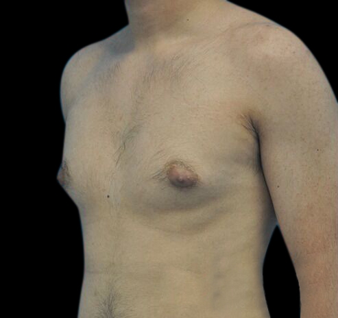 New Jersey Gynecomastia Before & After Gallery - Patient 55432625 - Image 5