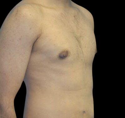 Gynecomastia Before & After Gallery - Patient 55432625 - Image 4