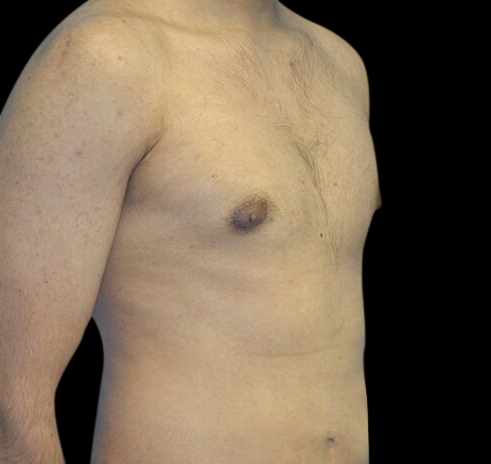 New Jersey Gynecomastia Before & After Gallery - Patient 55432625 - Image 4