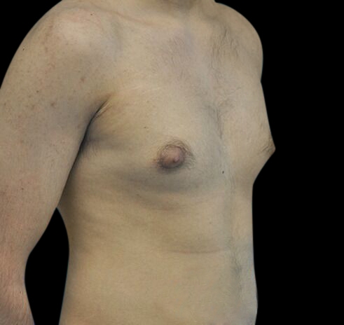 New Jersey Gynecomastia Before & After Gallery - Patient 55432625 - Image 3