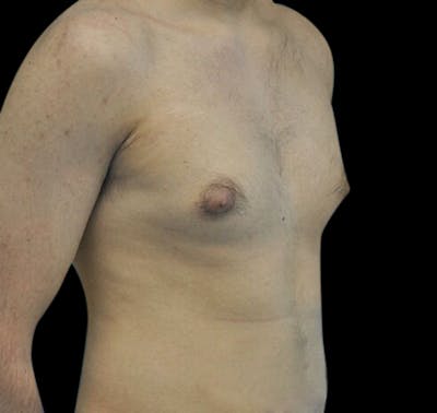 Gynecomastia Before & After Gallery - Patient 55432625 - Image 3