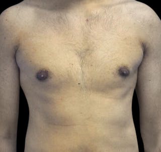 New Jersey Gynecomastia Before & After Gallery - Patient 55432625 - Image 2